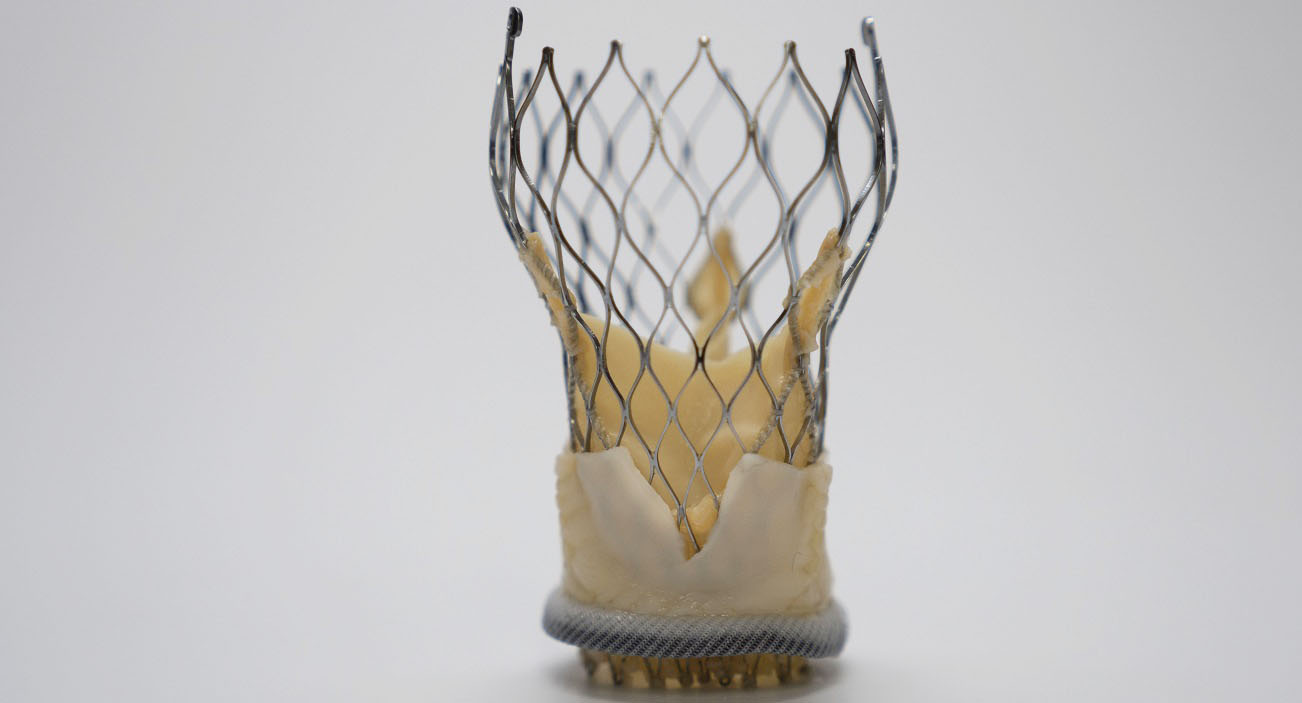 ViV TAVR New Durability and BASILICA Data Stress Need to Plan Ahead